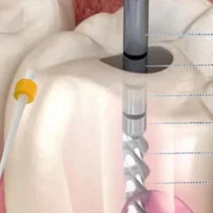 MATARIALES PARA ENDODONCIA