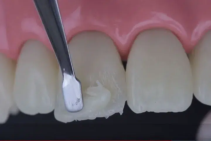 a close-up of a dental toolResinas Bulk Fill vs Convencionales: Comparativa para Restauraciones Posteriores